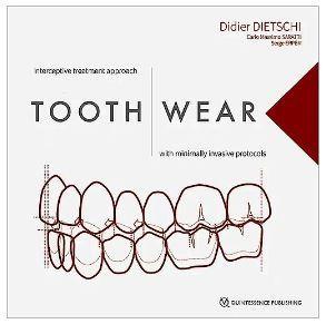 Tooth Wear. Interceptive treatment approach with minimally invasive protocols - CLNZ Books