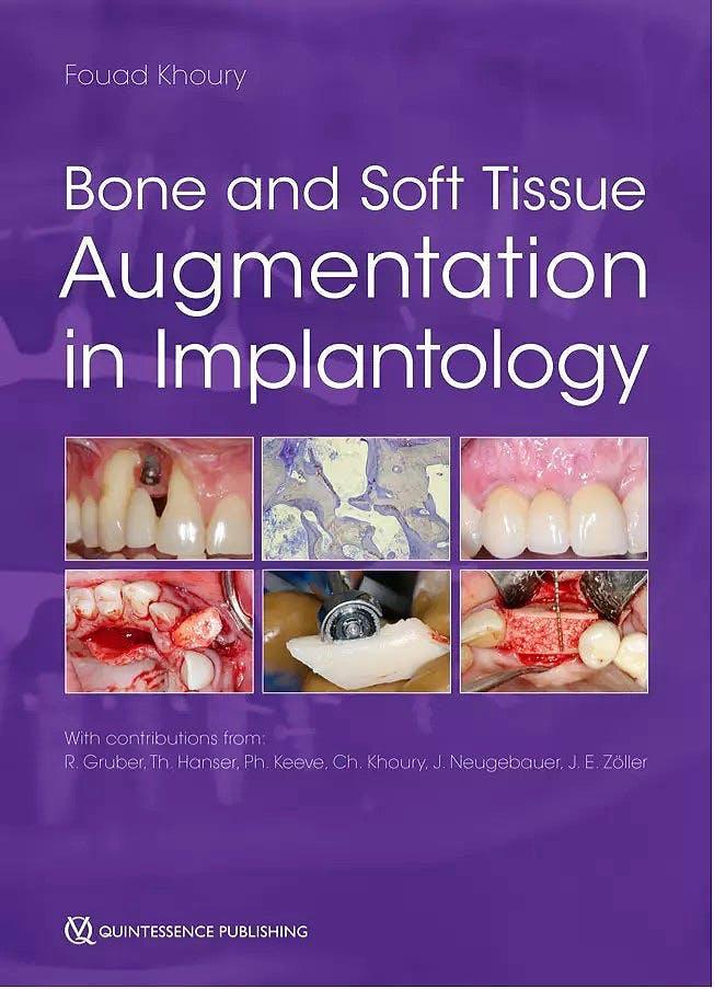 Bone and Soft Tissue Augmentation in Implantology - CLNZ Books