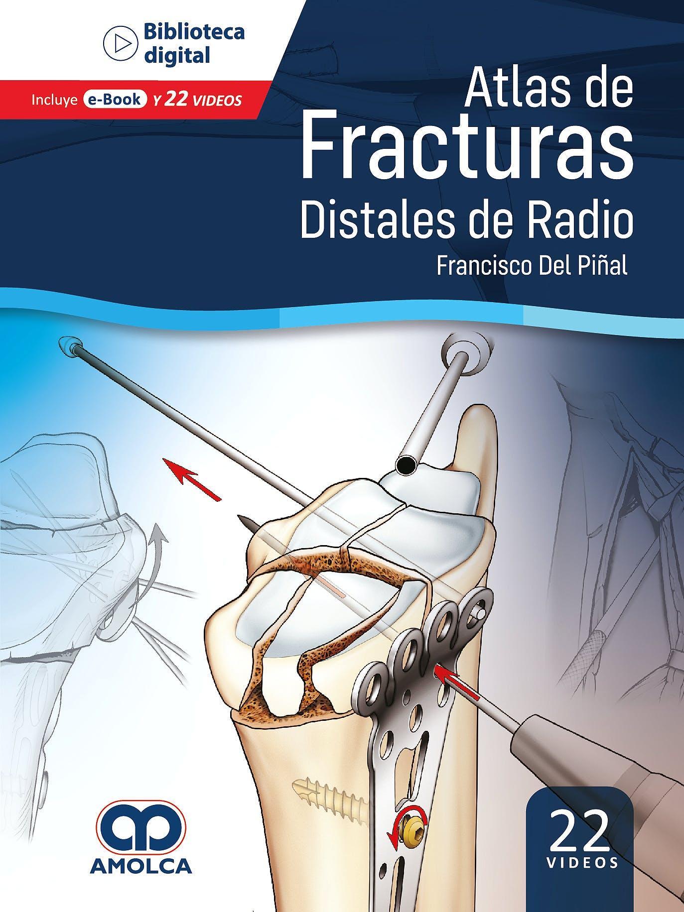 Atlas de Fracturas Distales de Radio - CLNZ Books