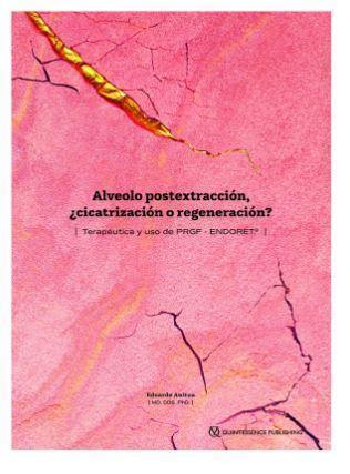 Alveolo postextracción, ¿cicatrización o regeneración? - CLNZ Books 